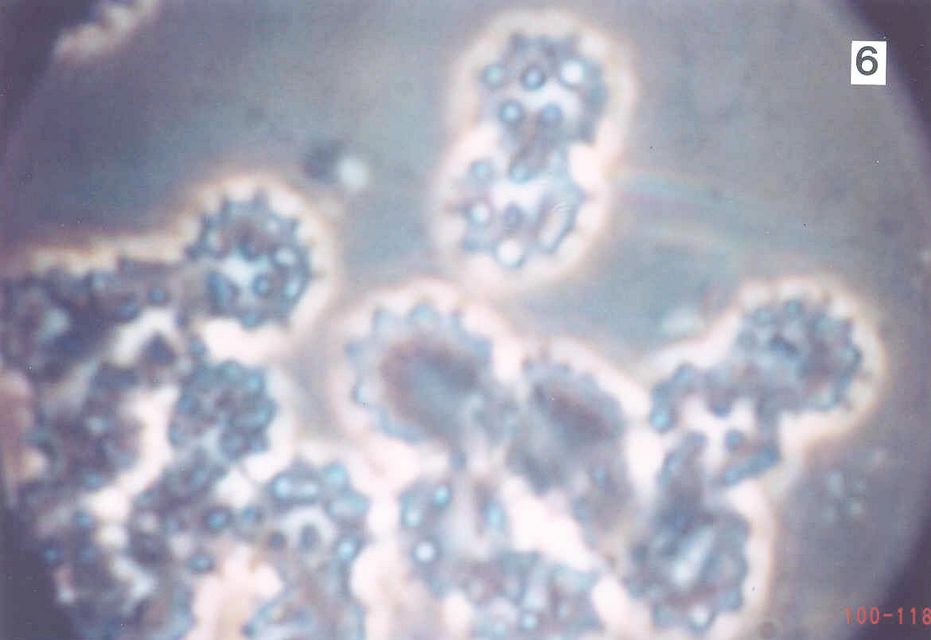 Blood cells heavily infected with cancer -  40x Phase contrast