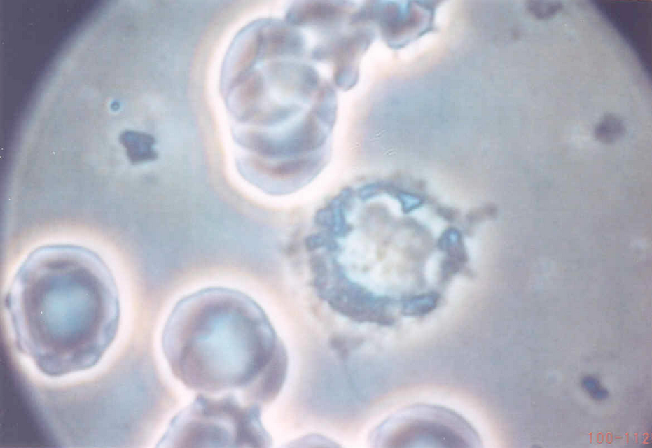 Blood cells heavily infected with cancer -  40x Phase contrast