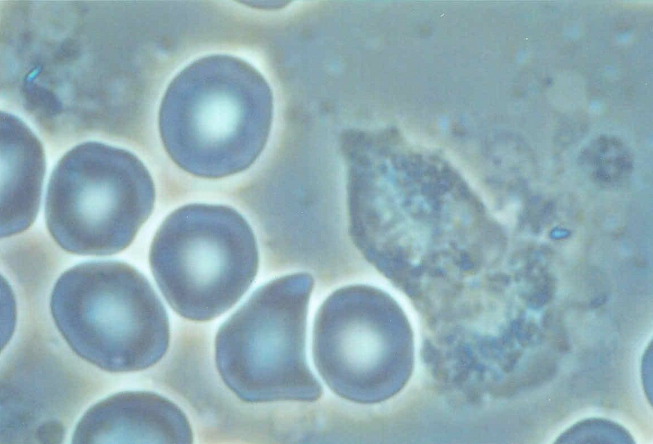 Healthy blood: erythrocytes, leucocytes