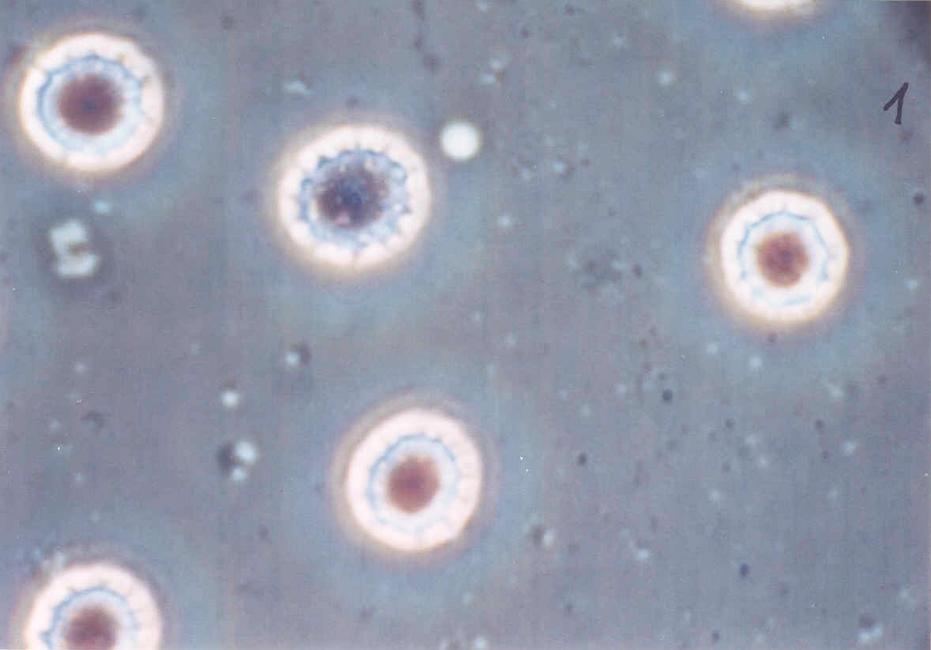 Leukemia - 40x Phase contrast